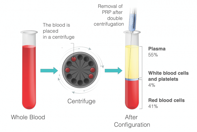 what is PRP - platelet rich plasma