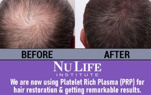 PRP for Hair Loss Treatment - Miami FL