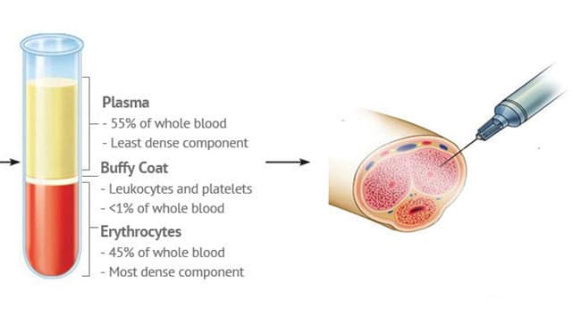 PRP for penis erection treatment