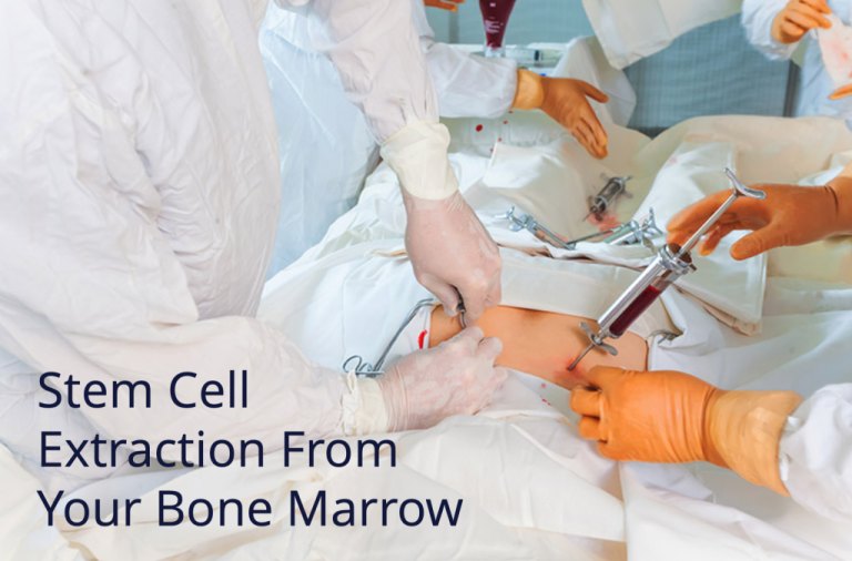 Stem cells being extracted from bone marrow for regenerative medicine treatment in Miami