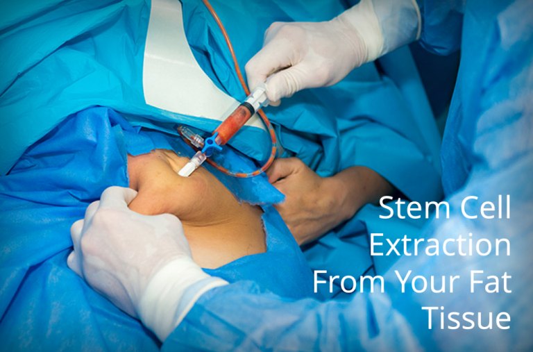 Stem cells being extracted from fat tissue for regenerative medicine treatment in Miami